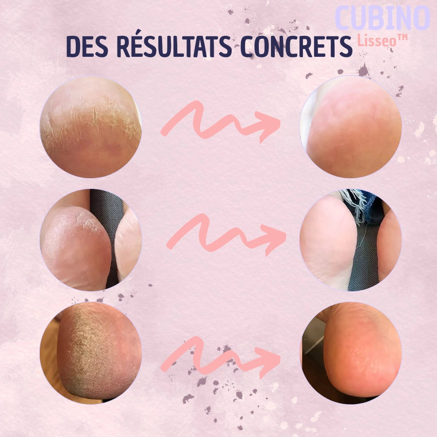 Lisseo™ – L’Essentiel pour des Pieds Doux